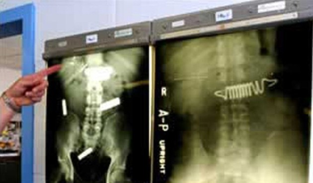 X-Rays of Foreign Objects in the Human Body