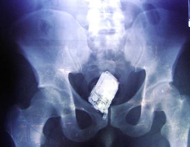 X-Rays of Foreign Objects in the Human Body