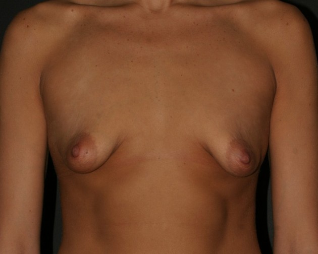 Some ugly ass breast's for you to gawk at...