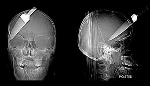 X-Rays of Foreign Objects in the Human Body