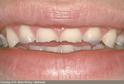 Oral Health - or lack there of