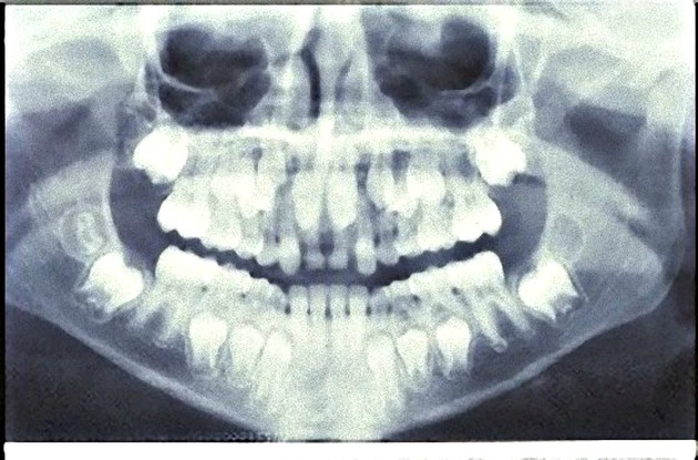 Hyperdontia: A Few Examples