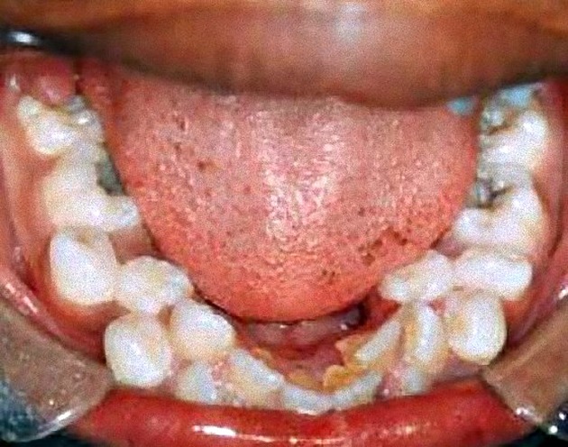 Hyperdontia: A Few Examples