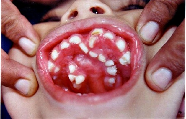 Hyperdontia: A Few Examples