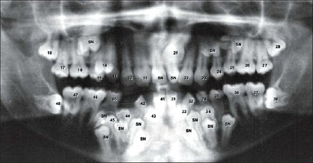 Hyperdontia: A Few Examples