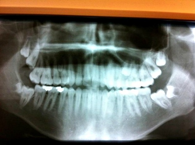 Hyperdontia: A Few Examples