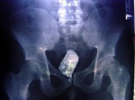 10 Craziest Foreign Objects Found Stuck In A Rectum