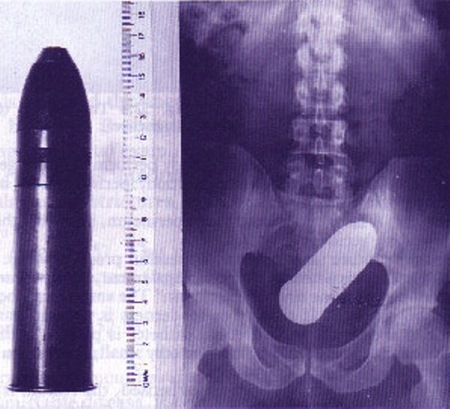 10 Craziest Foreign Objects Found Stuck In A Rectum