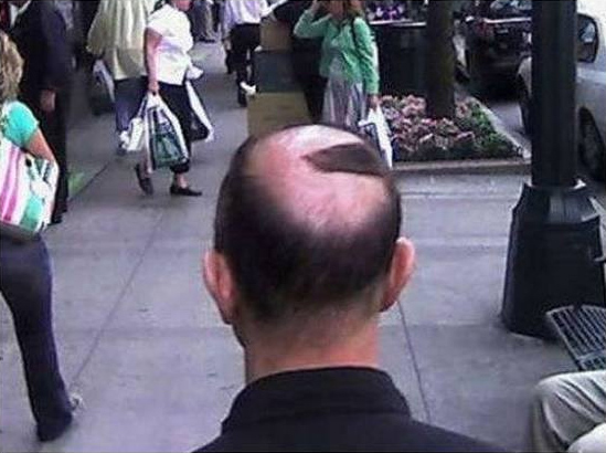 Going bald, Donald Trump needs to stop encouraging these folks...