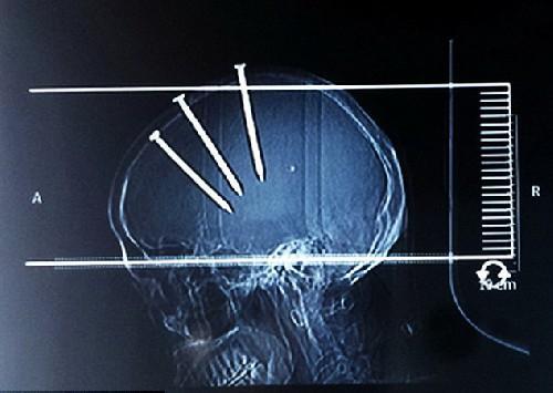 Mans Head Impaled With Three Huge Nails