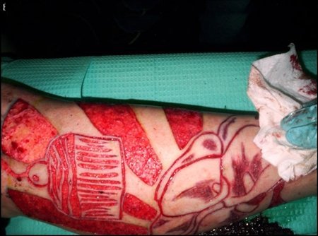 Scarification - the good and the bad