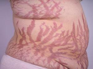 Stretch marks are the devils map