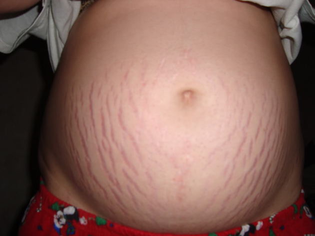 Stretch marks are the devils map