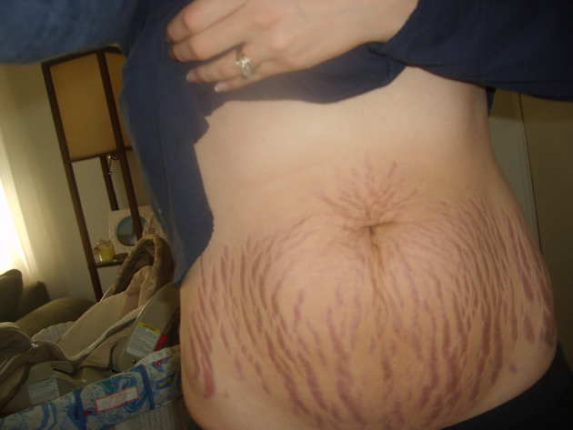 Stretch marks are the devils map