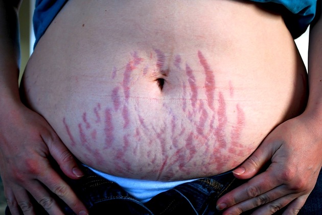 Stretch marks are the devils map