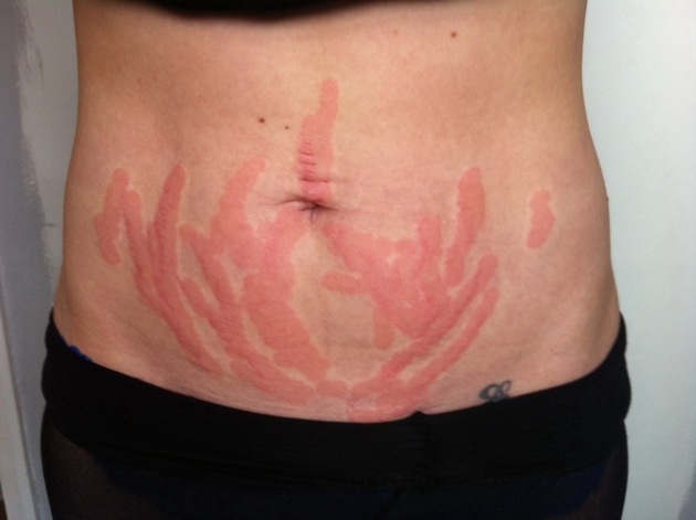 Stretch marks are the devils map