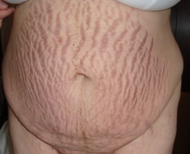 Stretch marks are the devils map