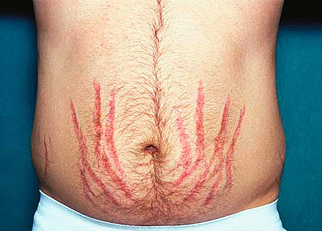 Stretch marks are the devils map