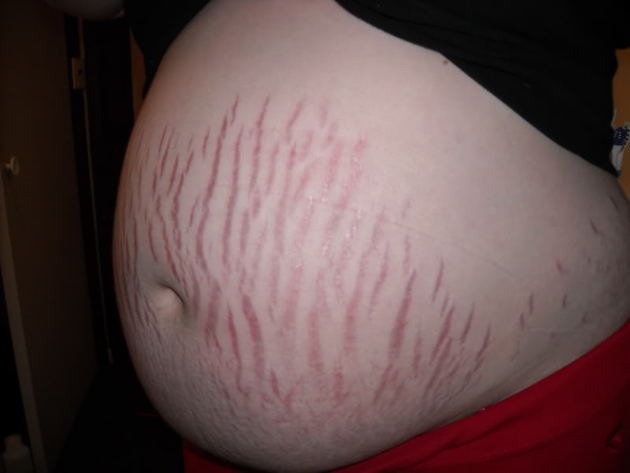 Stretch marks are the devils map