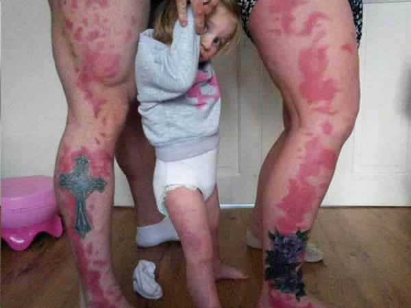 Most Awesome Birthmark & Scar Tattoos