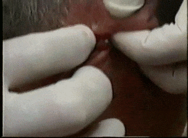 Pimples cysts and boils