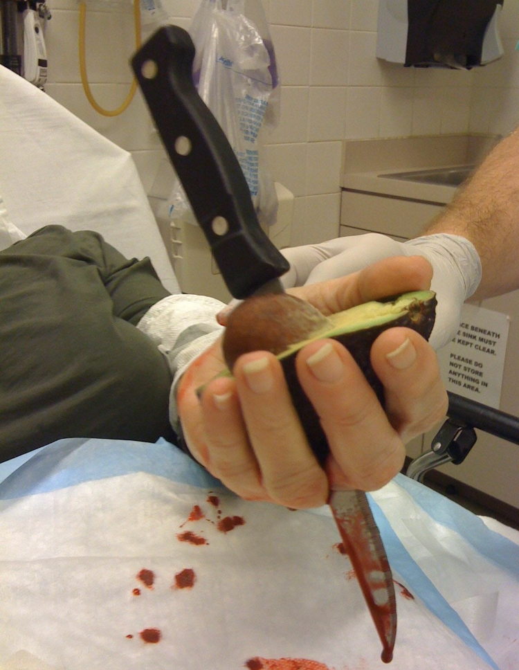 Man accidentally stabs himself trying to remove avocado seed.