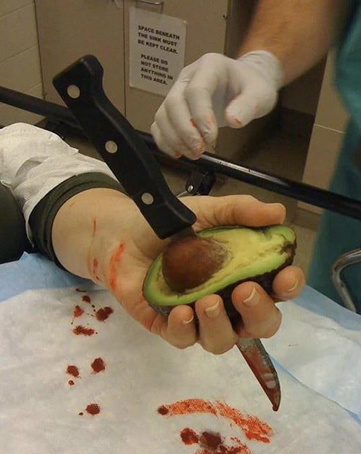 Man accidentally stabs himself trying to remove avocado seed.