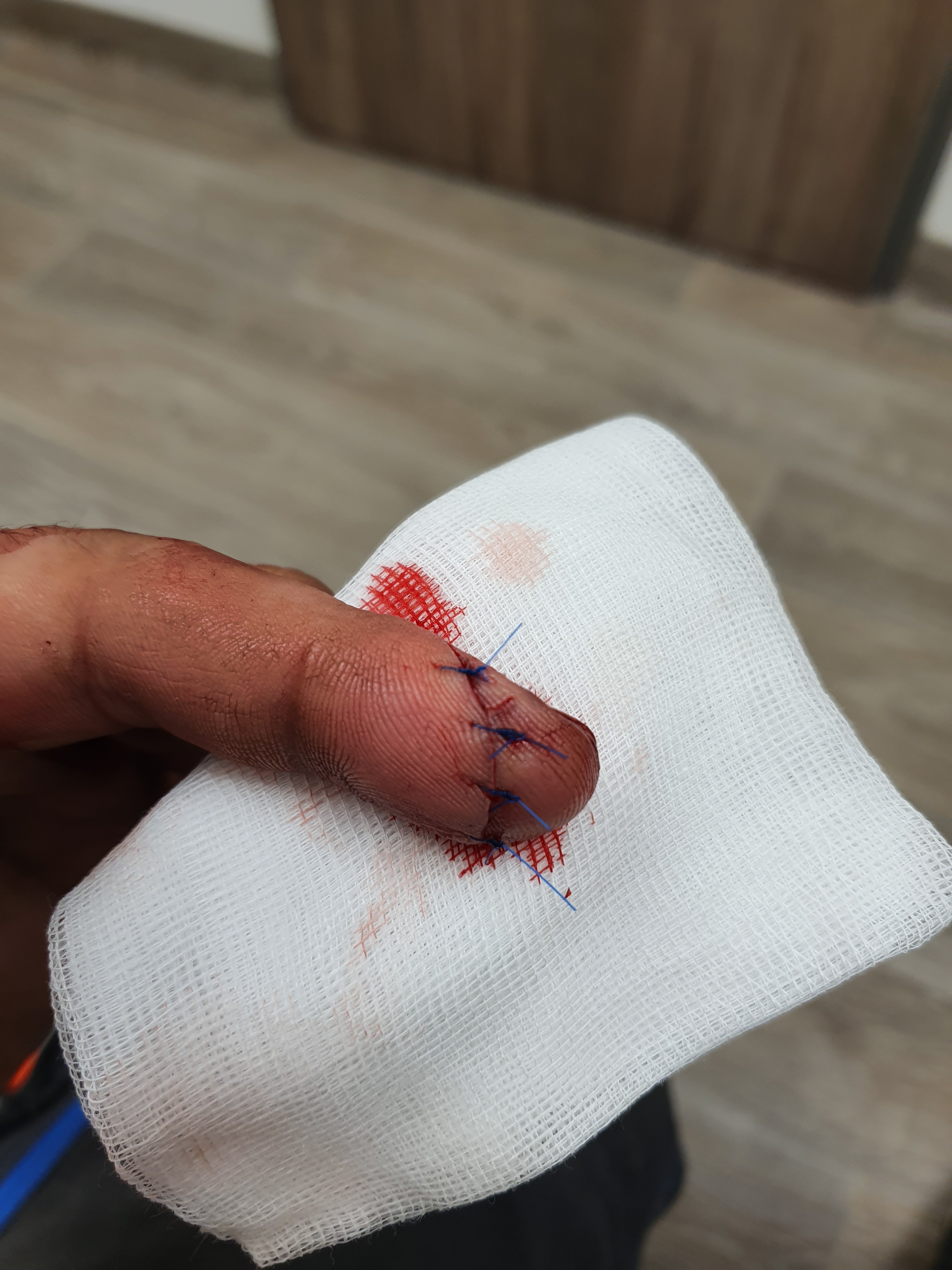 Angle grinder bit me