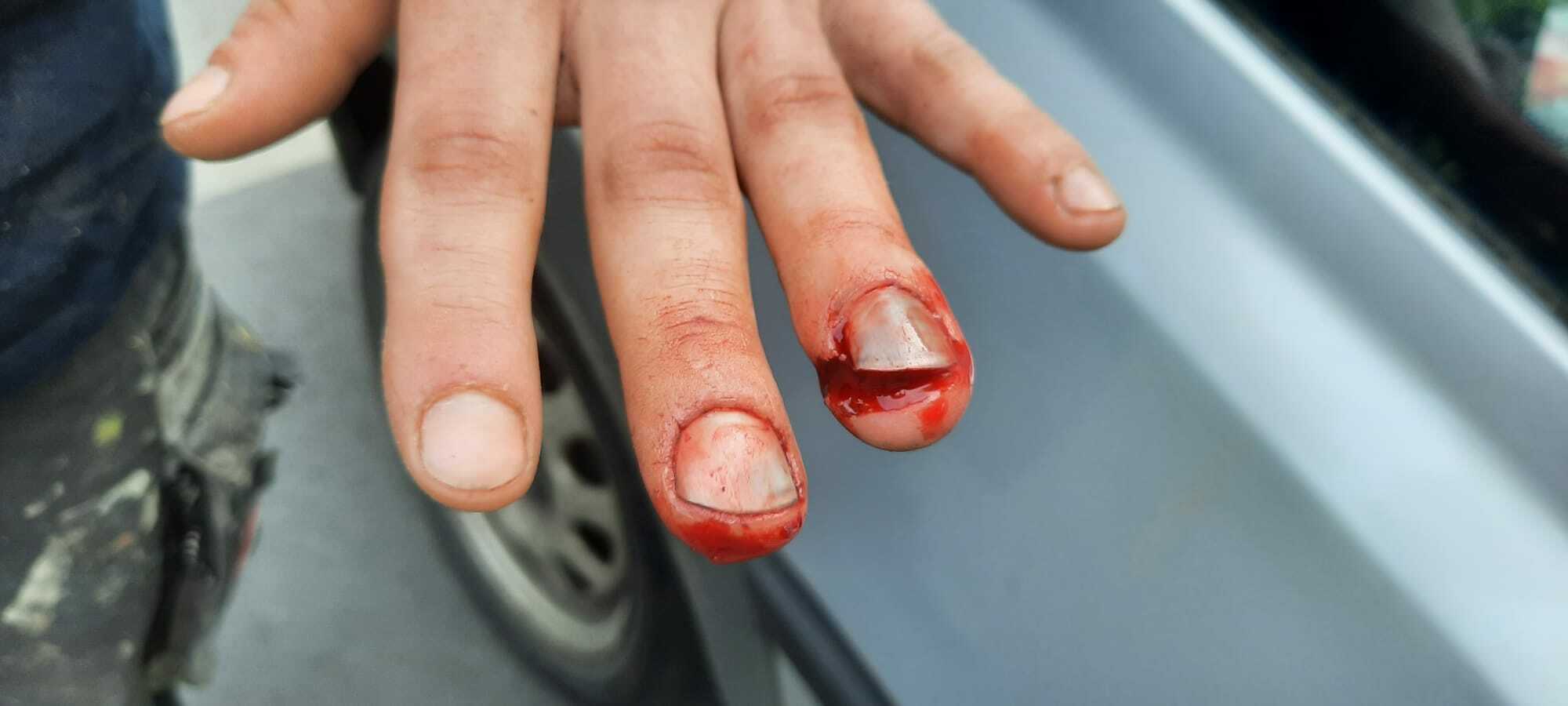 I can’t believe it myself , I crushed my finger :D