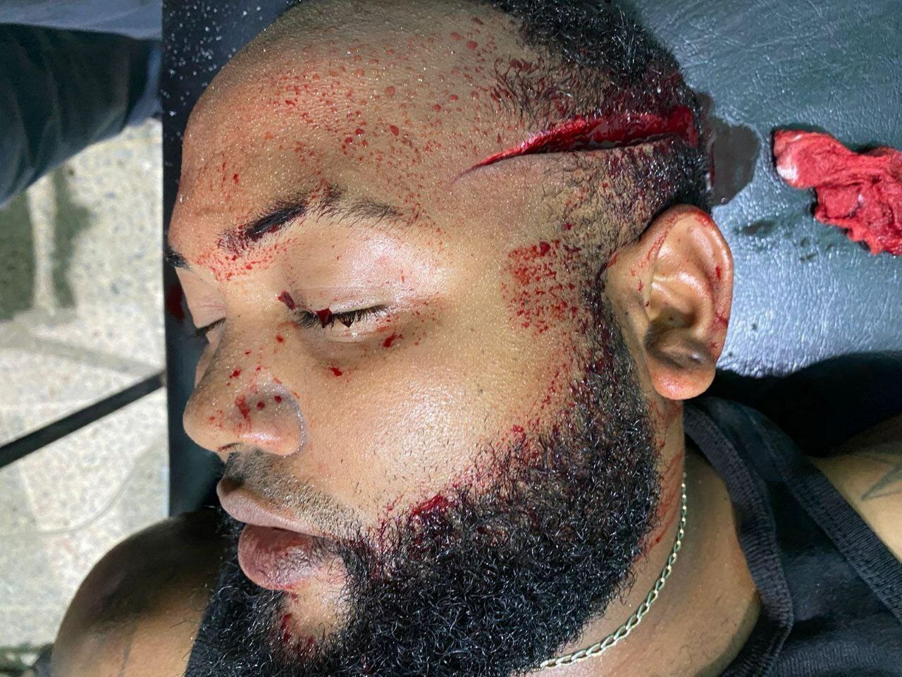 Aftermath Of That Machete Fight In Dominican Republic