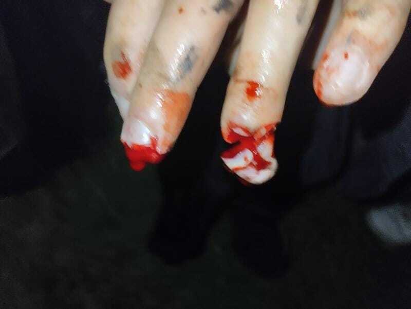 Severed fingers