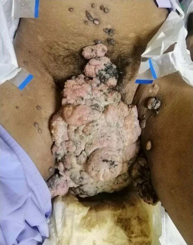 Kaposi's Sarcoma