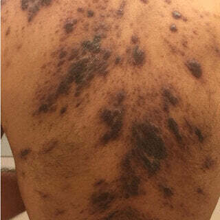 Kaposi's Sarcoma