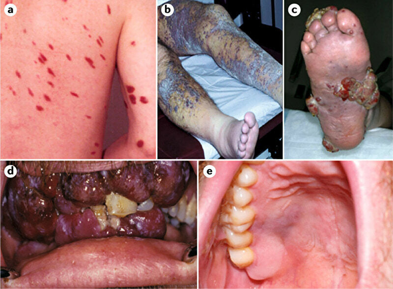 Kaposi's Sarcoma