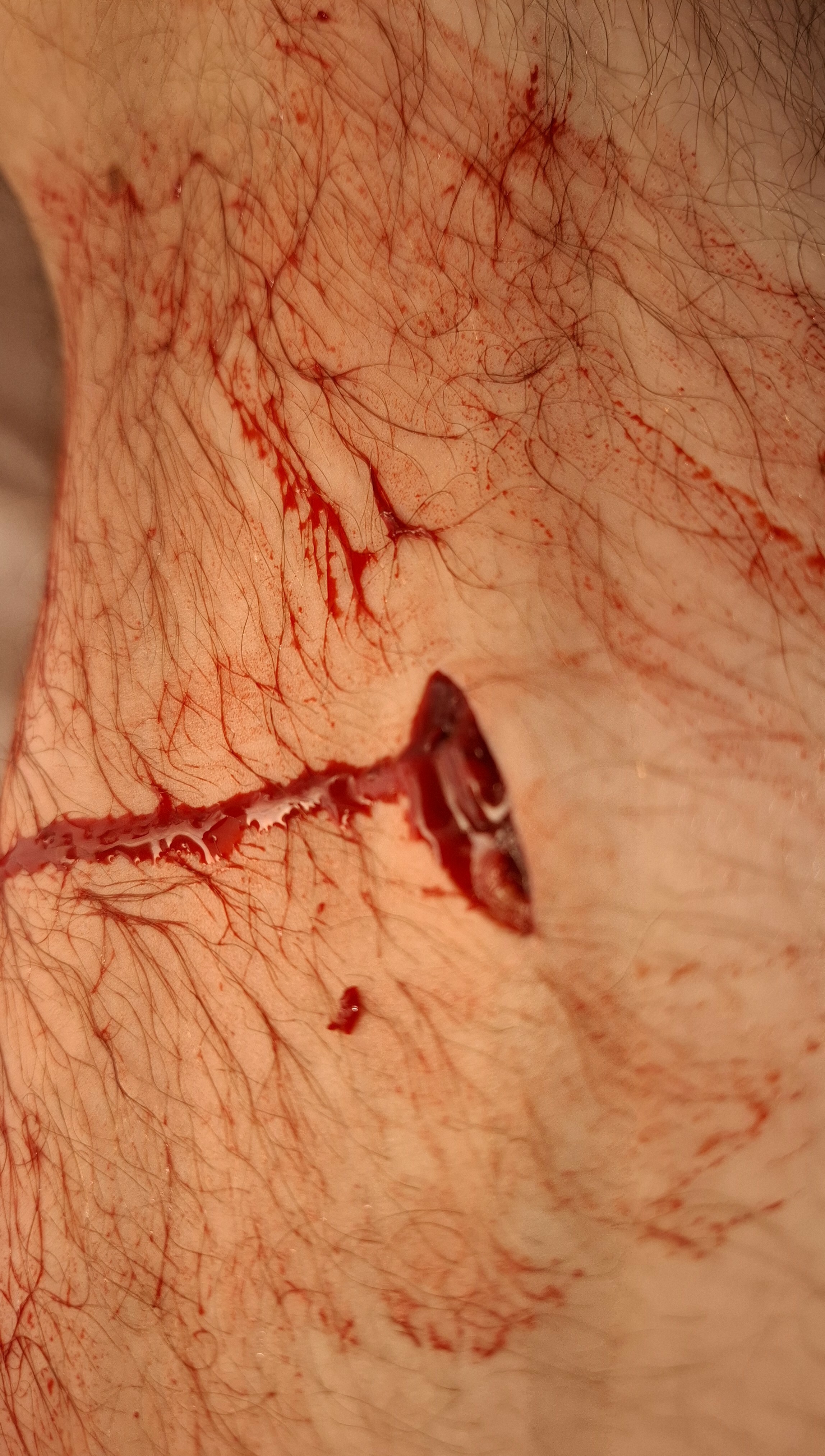 Accidental Stab Wound