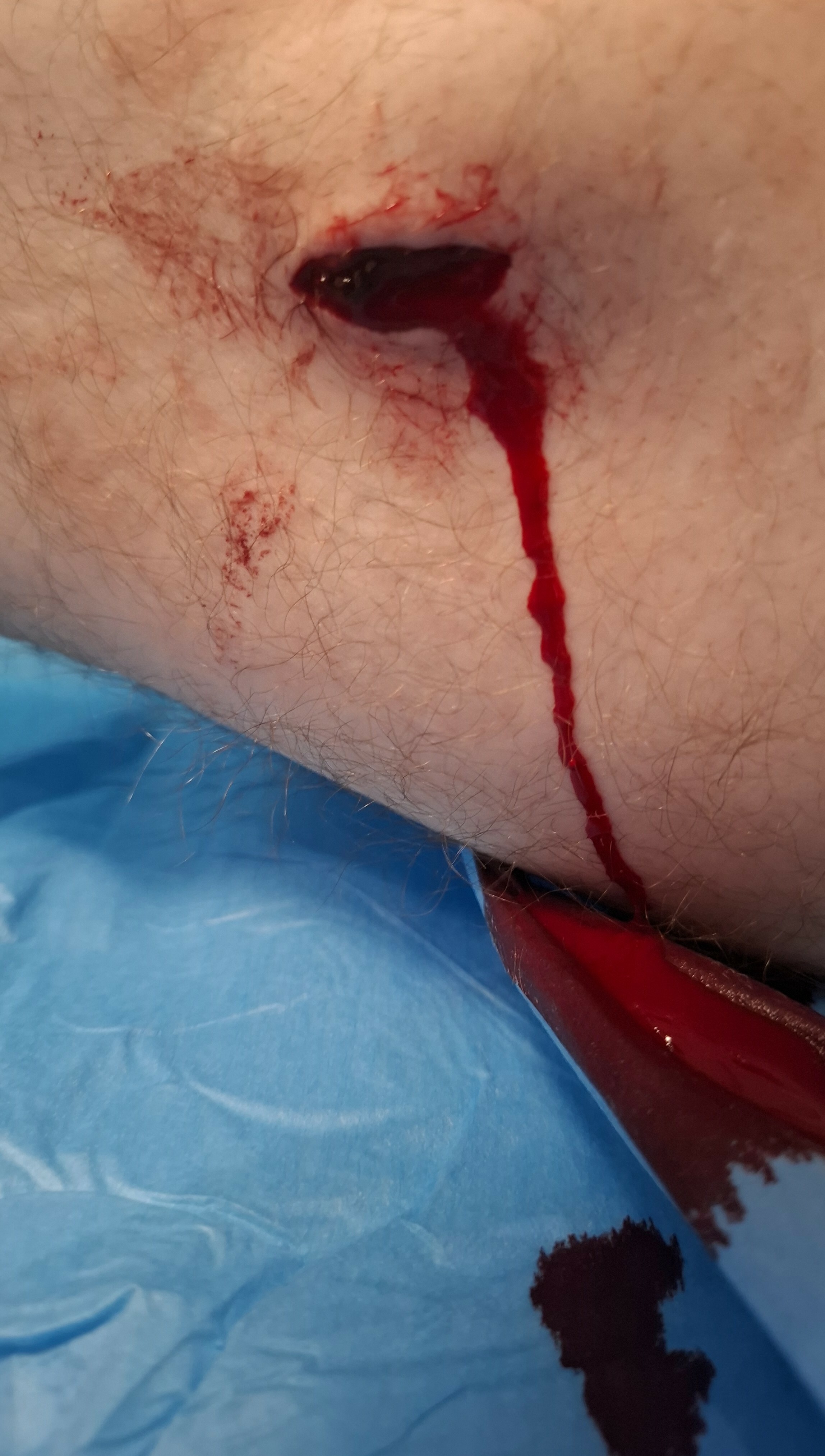 Accidental Stab Wound