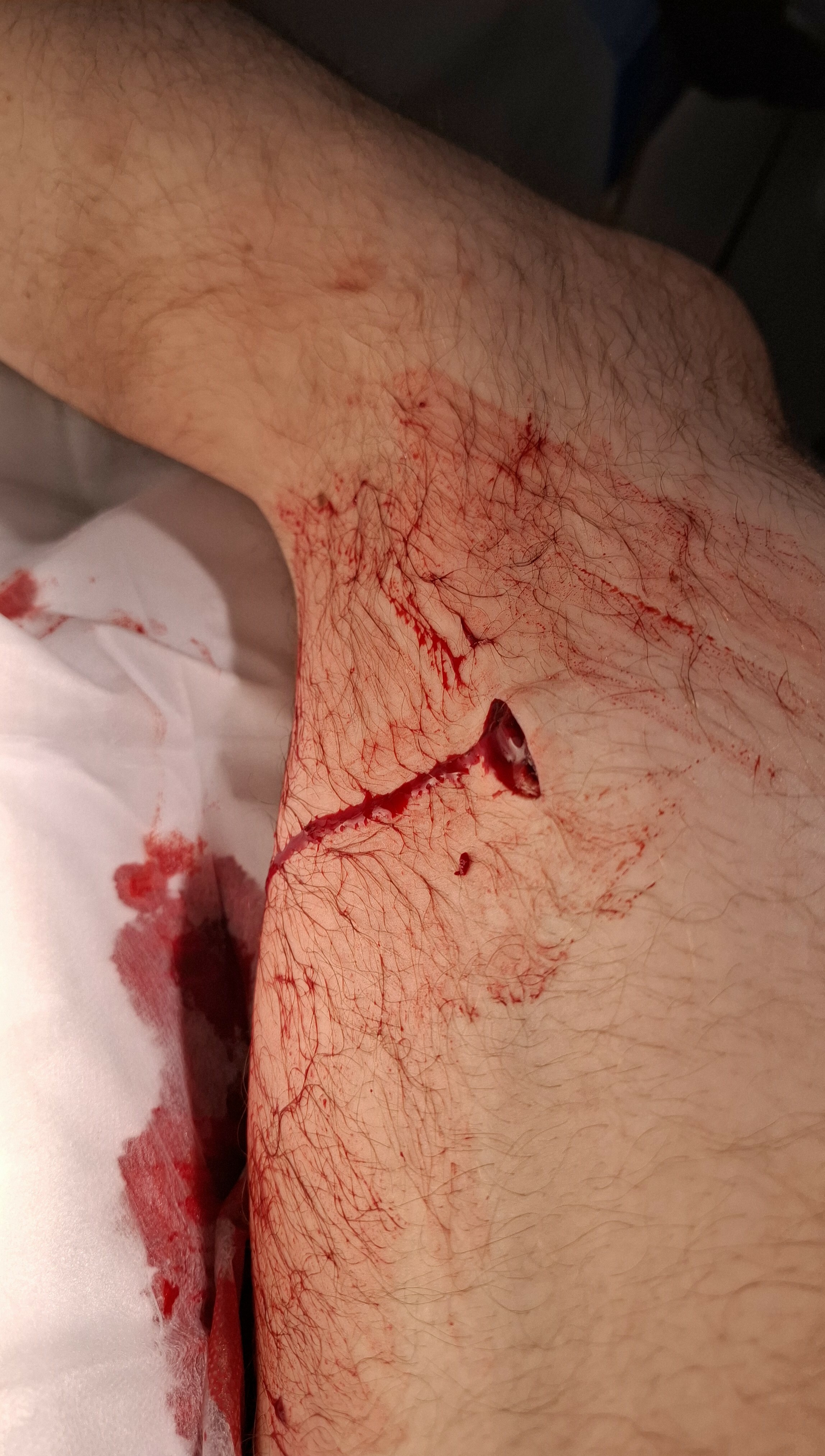 Accidental Stab Wound