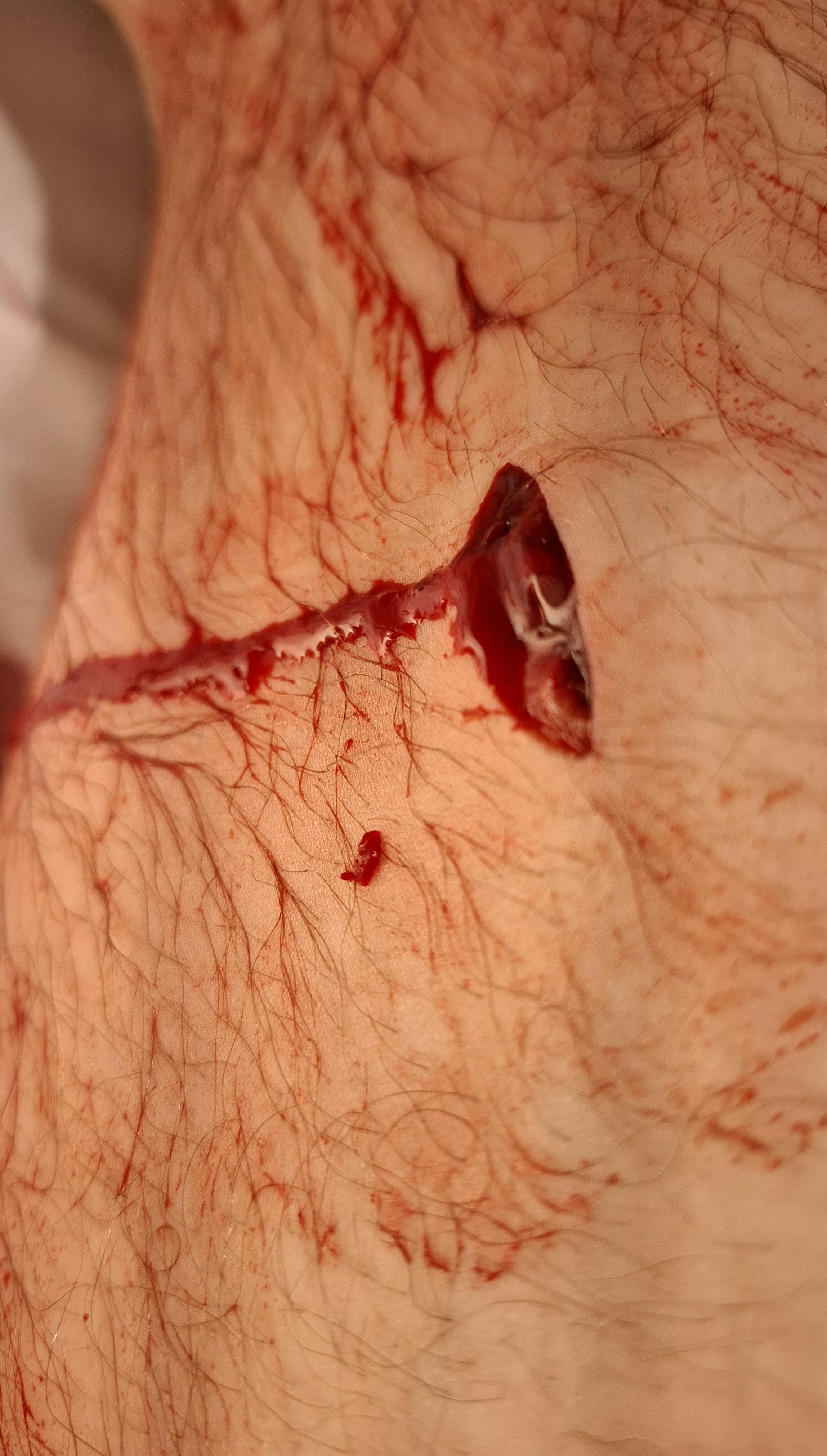 Accidental Stab Wound