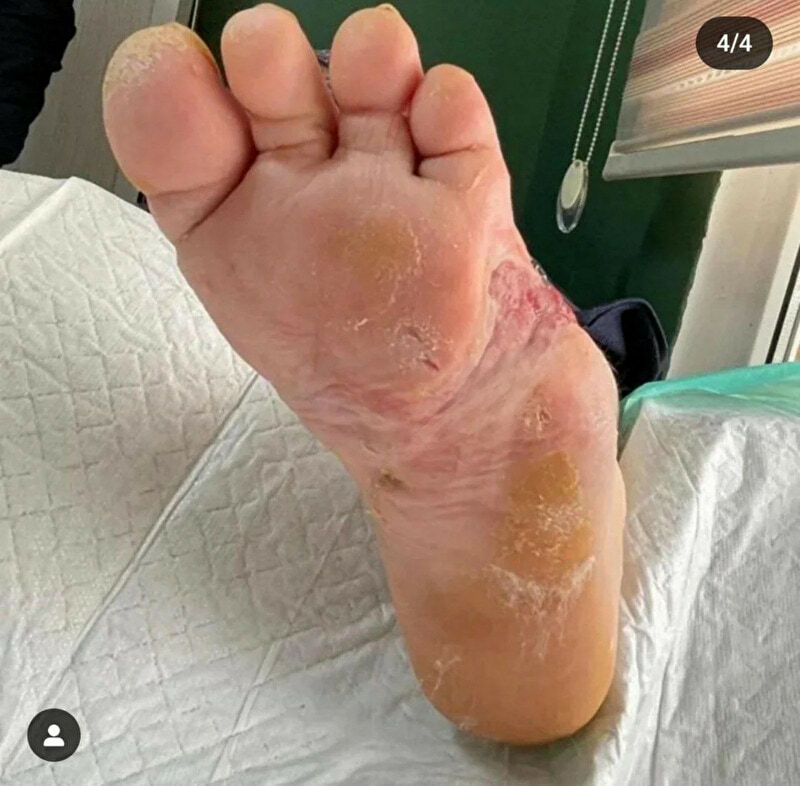 Maggot Therapy Gallery