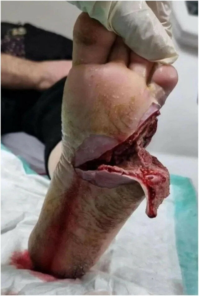 Maggot Therapy Gallery