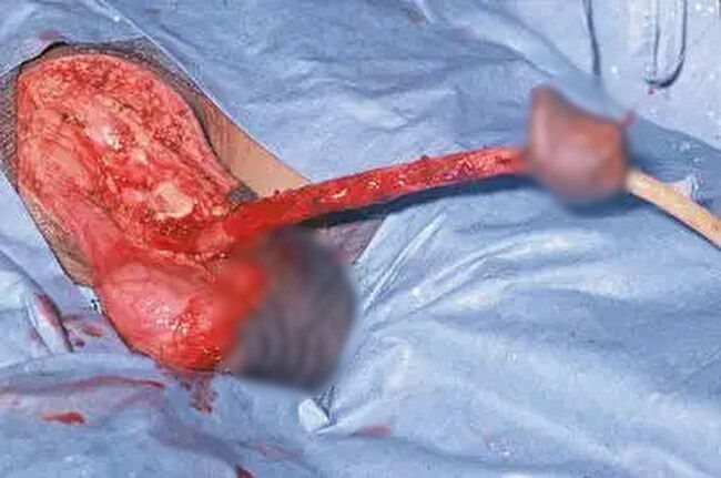 Weiner Cancer Cure Pic