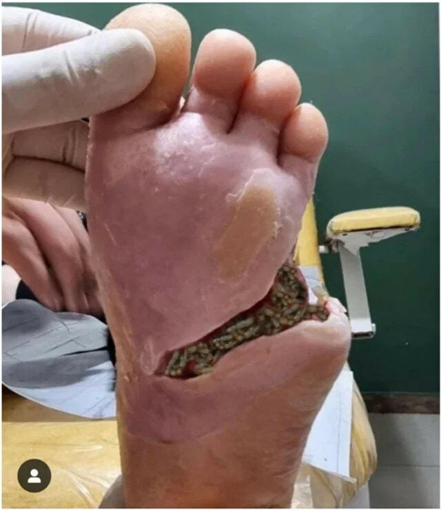 Maggot Therapy Gallery