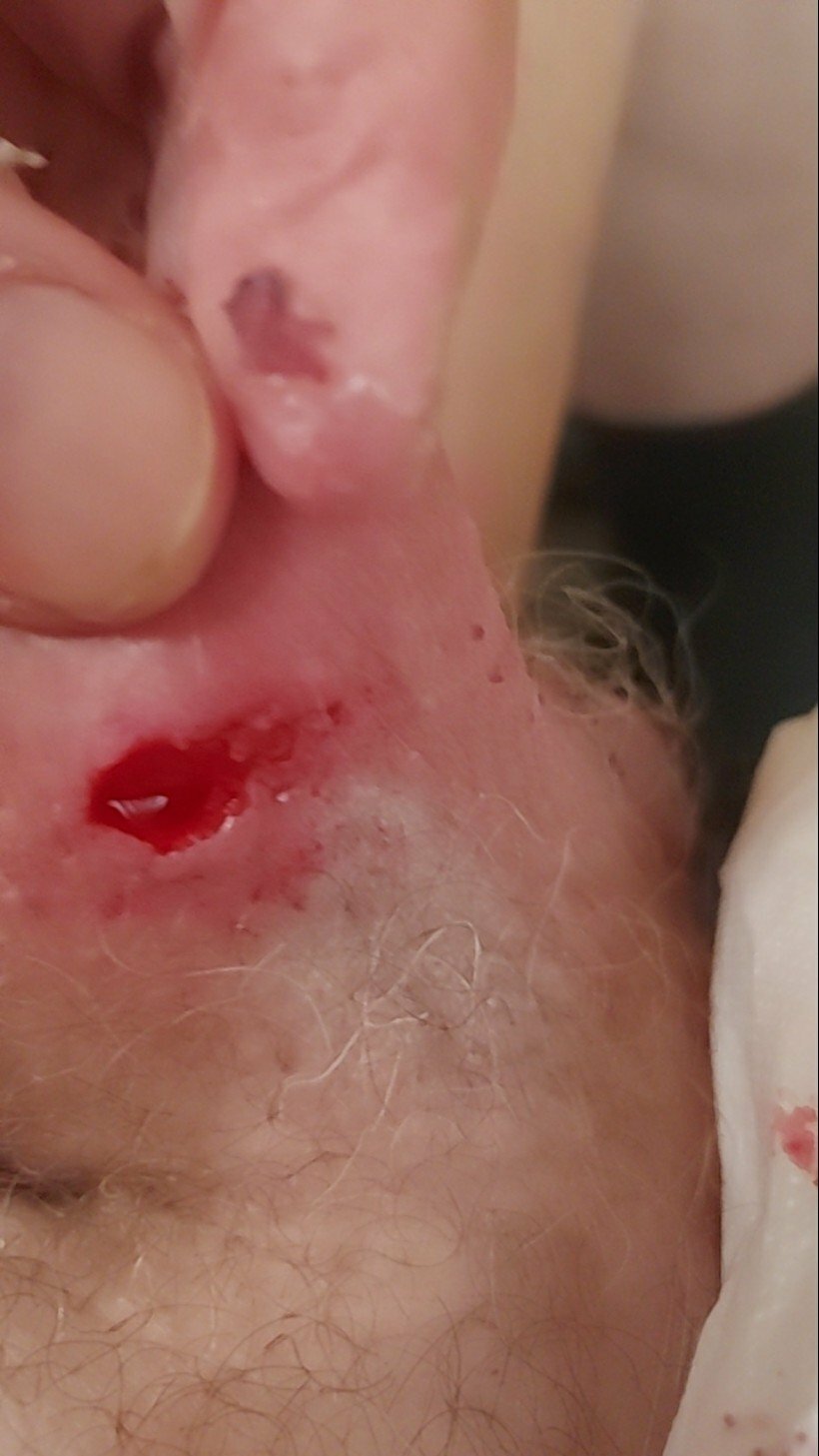brumeato / scrotum cut open