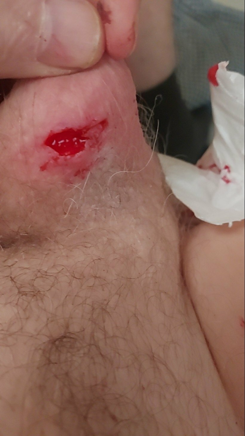brumeato / scrotum cut open