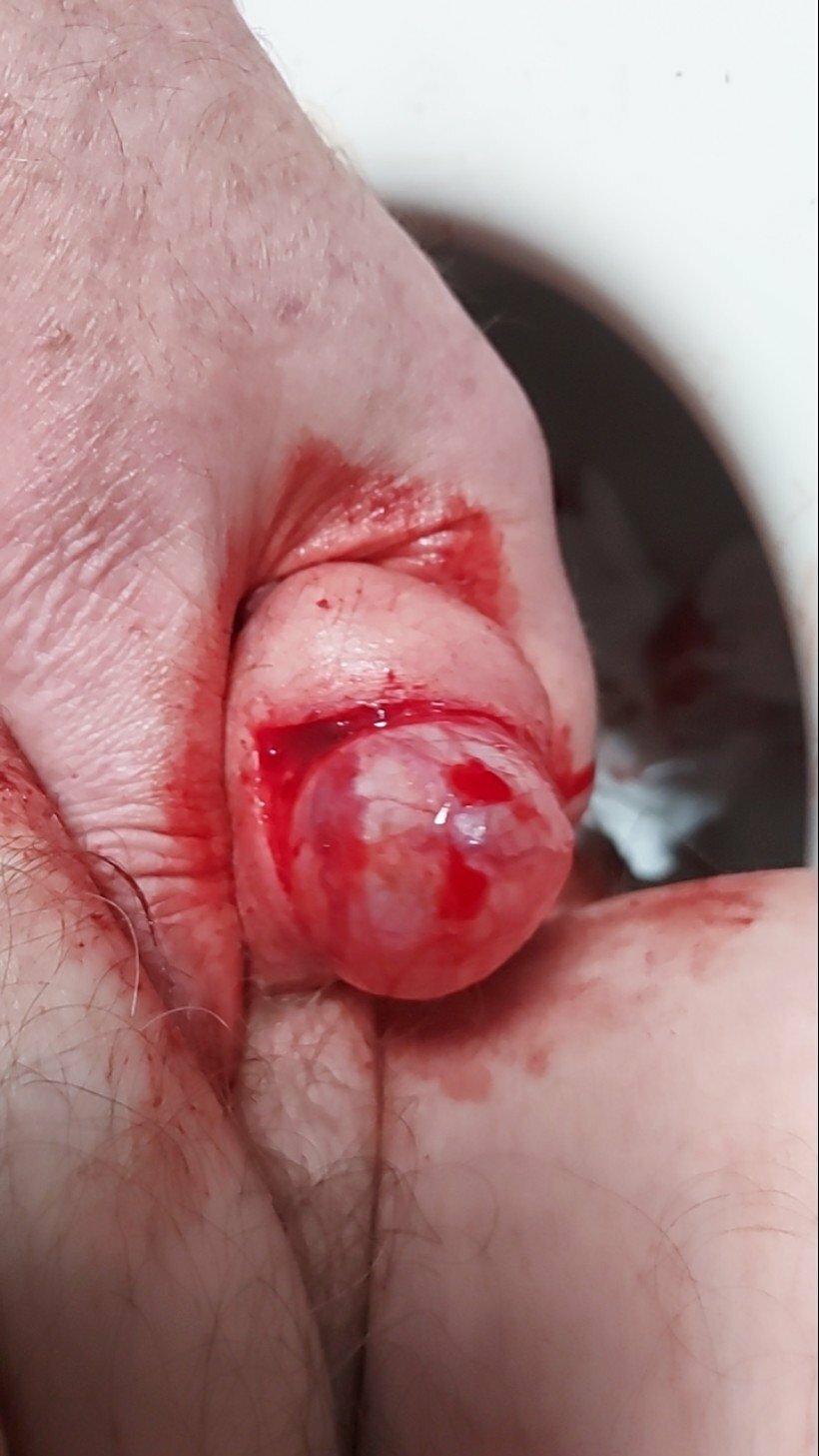 brumeato / scrotum cut open
