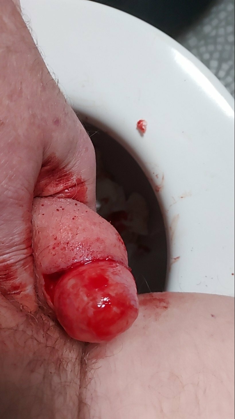 brumeato / scrotum cut open