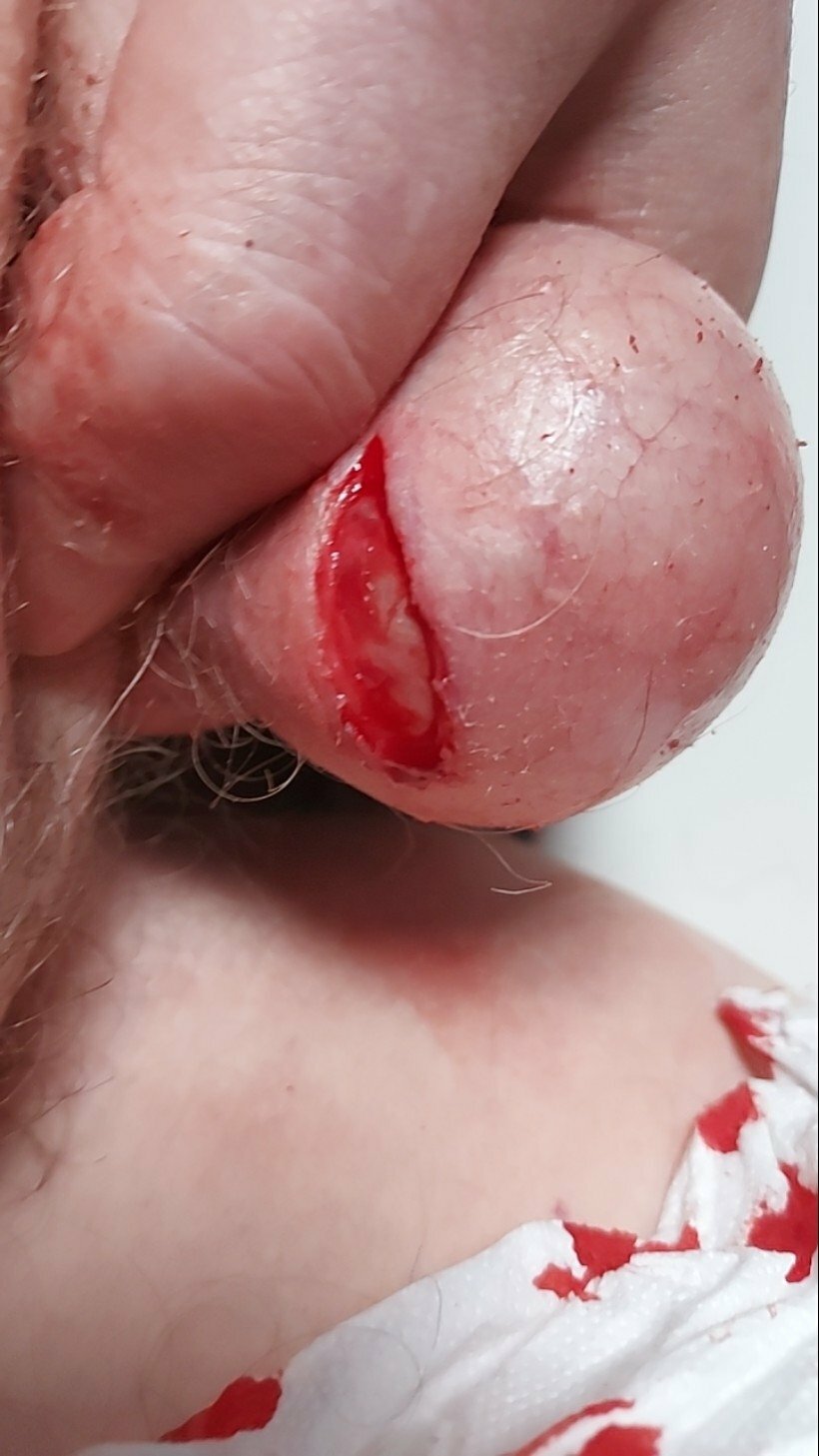 brumeato / scrotum cut open