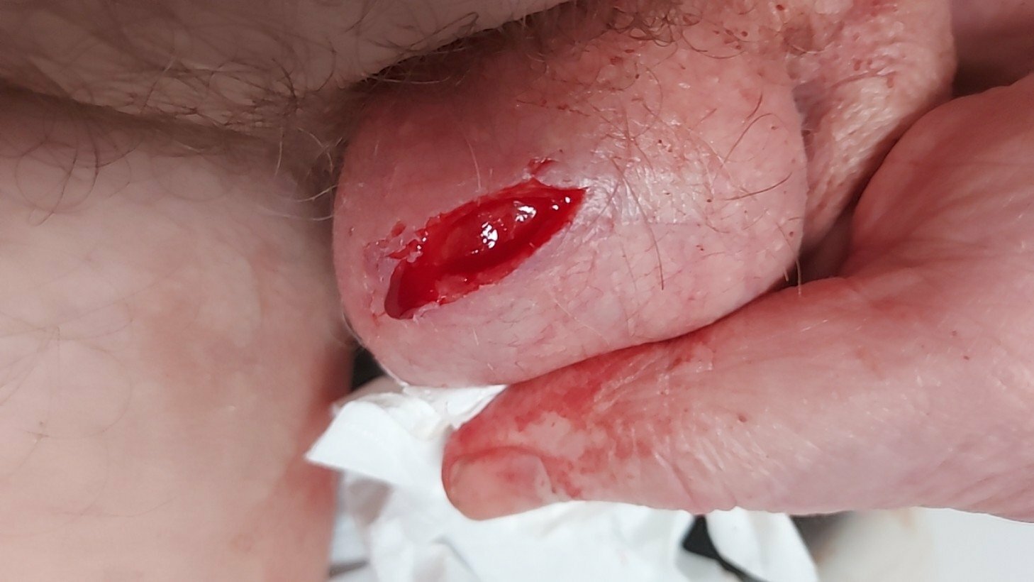 brumeato / scrotum cut open