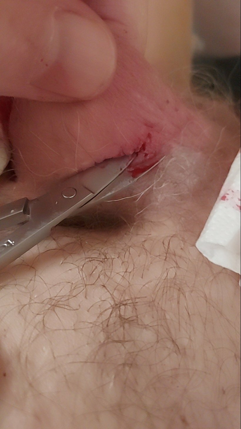 brumeato / scrotum cut open