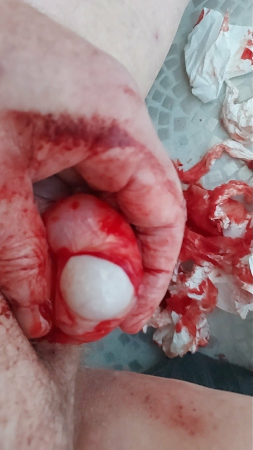 brumeato / scrotum cut open